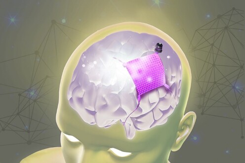 Minimal Invasive Subdural Electrocorticographic Brain-Computer Interface